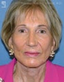 Facelift, Brow Lift & Eyelid Surgery