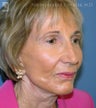 Facelift, Brow Lift & Eyelid Surgery