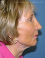 Facelift, Brow Lift & Eyelid Surgery