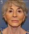 Facelift