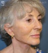 Facelift