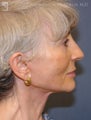 Facelift