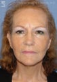 Facelift & Eyelid Surgery