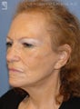 Facelift & Eyelid Surgery