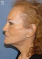 Facelift & Eyelid Surgery
