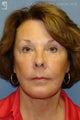 Facelift, Eyelid Surgery & Chin Implant