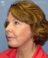 Facelift, Eyelid Surgery & Chin Implant