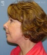Facelift, Eyelid Surgery & Chin Implant