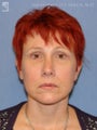 Facelift, Brow Lift & Lower Blepharoplasty