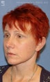 Facelift, Brow Lift & Lower Blephroplasty