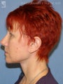 Facelift, Brow Lift & Lower Blepharoplasty