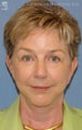 Facelift & Lower Blepharoplasty