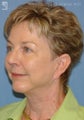 Facelift & Lower Blepharoplasty