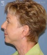 Facelift & Lower Blepharoplasty