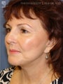 Facelift