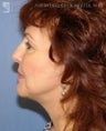 Facelift