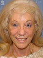 Facelift, Brow Lift & Eyelid Surgery