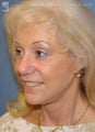 Facelift, Brow Lift & Eyelid Surgery