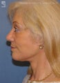 Facelift, Brow Lift & Eyelid Surgery