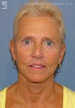Facelift & Lower Blepharoplasty