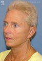Facelift & Lower Blepharoplasty