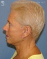 Facelift & Lower Blepharoplasty