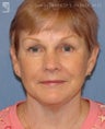 Facelift, Brow Lift & Lower Blepharoplasty