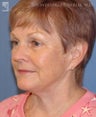 Facelift, Brow Lift & Lower Blepharoplasty