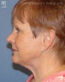Facelift, Brow Lift & Lower Blepharoplasty