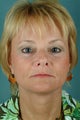 Facelift