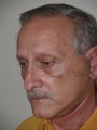 Facelift Procedure