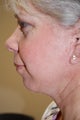 Facelift