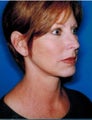 Facelift