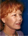 Facelift