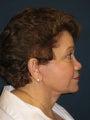 Facelift