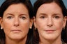 Face lift, Endoscopic Brow lift, Chin Augmentation and Upper Blepharoplasty