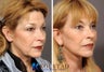 Facelift