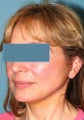 Facelift