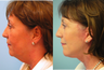 Facelift, necklift, upper & lower blepharoplasty