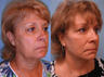 Facelift, necklift, upper & lower blepharoplasty