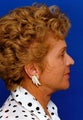 Facelift