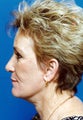 Facelift