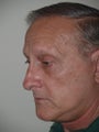 Upper and Lower Blepharoplasty