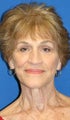 Facelift, Browlift, & Skin Pinch
