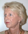 Facelift