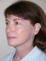 Facelift