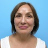Facelift