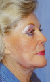 Facelift