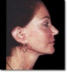 Facelift