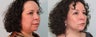 Facelift